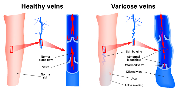 Best Varicose Veins Treatment in Mohali