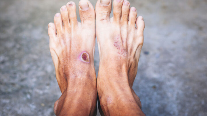 The Connection Between Diabetes and Foot Problems | Dr. Ravul Jindal